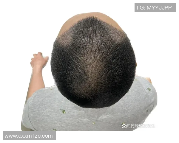 足球明星植发前后对比揭秘他们的发型变化与自信重塑之路 足球明星植发前后对比揭秘他们的发型变化与自信重塑之路